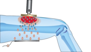 radiofrecuencia en fisoterapia Alpedrete