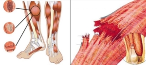 rotura de fibras o desgarro muscular