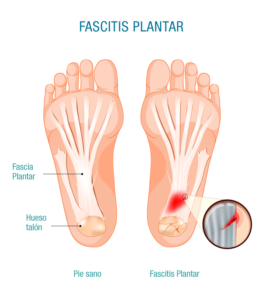 fascitis plantar